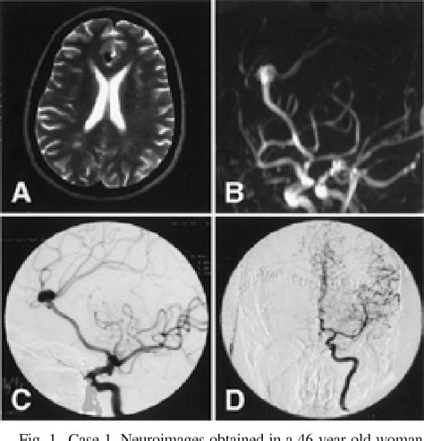 Pdf Nonsaccular Aneurysms Of The Azygos Anterior Cerebral Artery