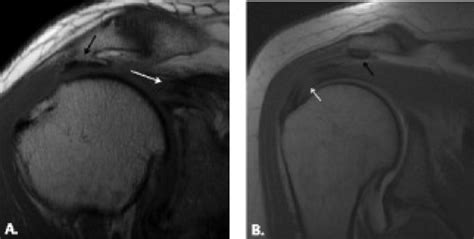 Subacromial Spur Mri