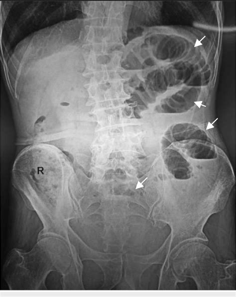 Figure 1 From An Unusual Case Of Obturator Hernia Detected In An