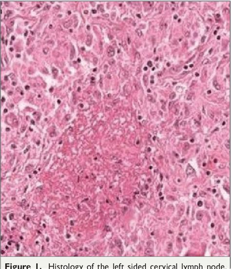 Figure From Acute Kidney Injury As The Presenting Feature Of