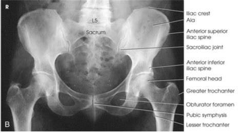 Chp 08 Pelvis Hip Flashcards Quizlet