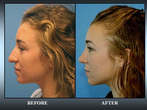 Ethnic Rhinoplasty in California Community | Sadati, MD