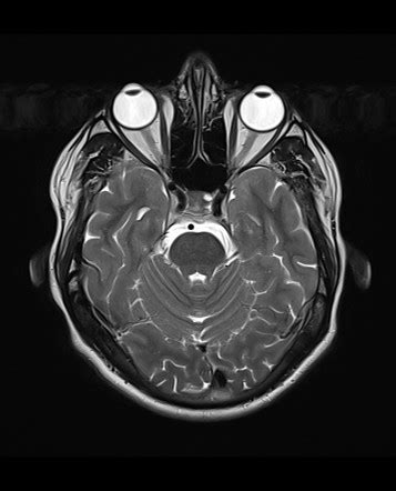 Pituitary Gland Cyst Mri