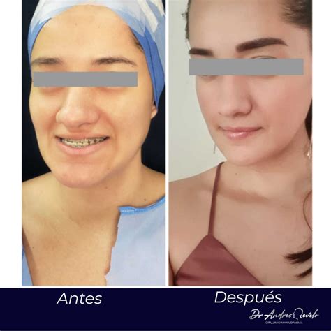 Mentoplastia Antes Y Despu S Clinicasesteticas Co