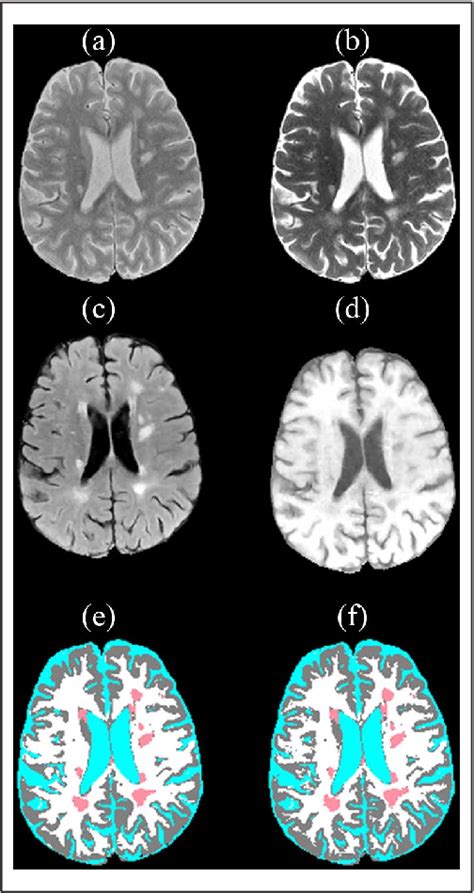 Figure 1 From Brain And Lesion Segmentation In Multiple Sclerosis Using Fully Convolutional