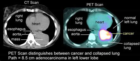 Xrays and CT Scans of Lung Cancer