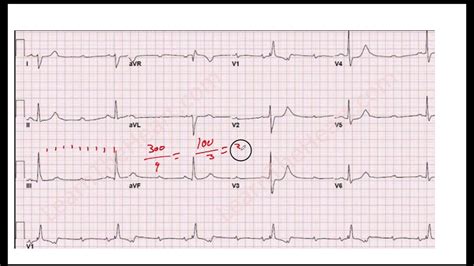 Ejercicios De Practica Método 1 Determinación Frecuencia Cardiaca Ekg Youtube