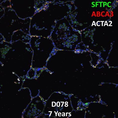 Year Old Human Lung With Asthma Immunofluorescence And Confocal