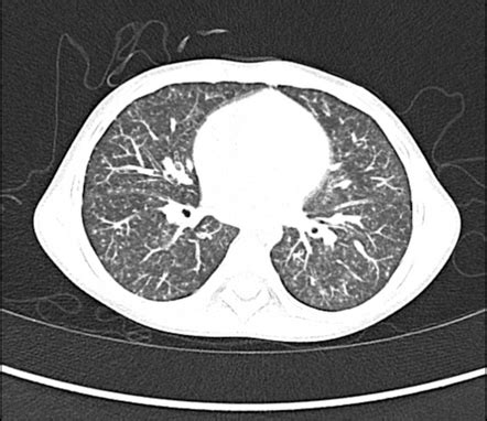 Tropical Pulmonary Eosinophilia Radiology Case Radiopaedia Org