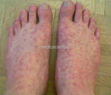 Rickettsial Diseases ROCKY MOUNTAIN AFRICAN TICK BITE RICKETTSIAL POX ...