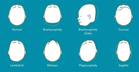 Plagiocephaly – My GP Notes