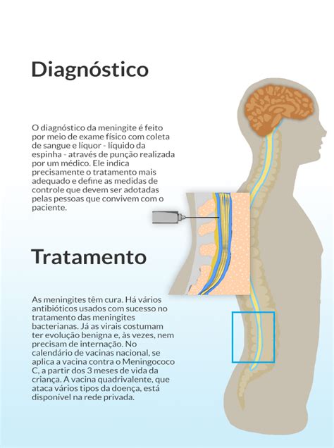 Meningite