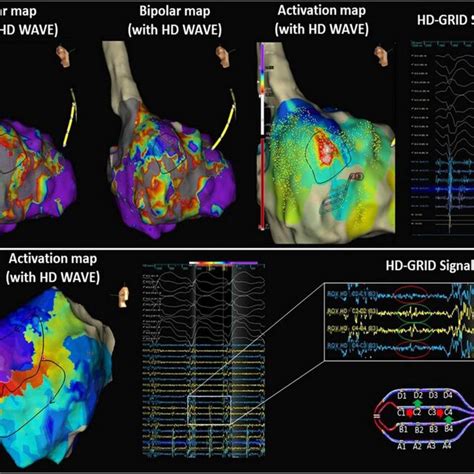 Electroanatomical Maps EAMs Of The Left Ventricle In 2 Representative