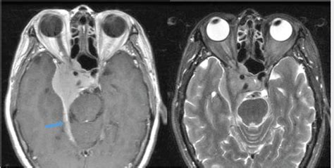 Sellar Parasellar And Clival Region Radiology Key