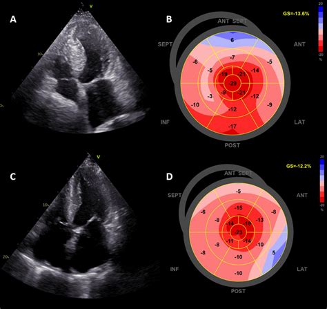 Global Longitudinal Strain Clinical Use And Prognostic Implications In