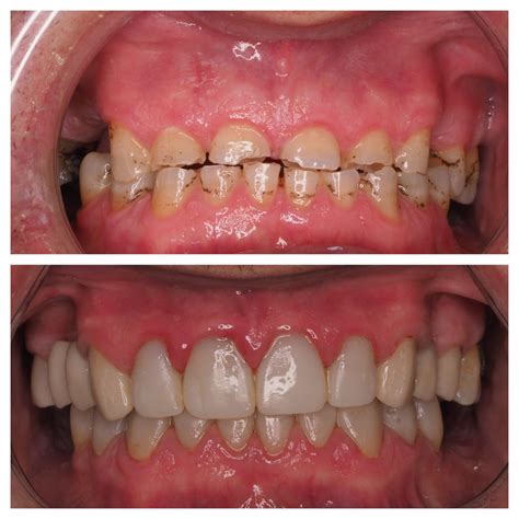 Carillas Est Ticas De Composite Cl Nica Dental Juan Jes S Zambrana