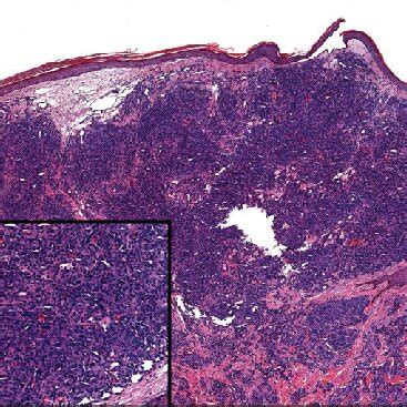 Squamoid Eccrine Ductal Carcinoma Cytologically Atypical Squamoid