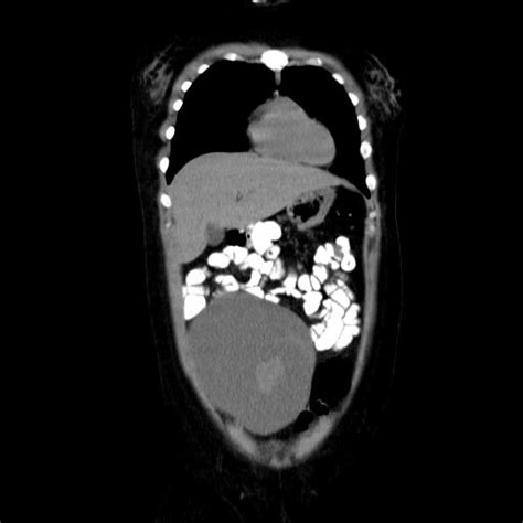 Serous Ovarian Cystadenocarcinoma Image