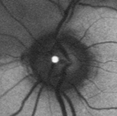 Branch Retinal Artery Occlusion With Calcium Embolus At The Disc