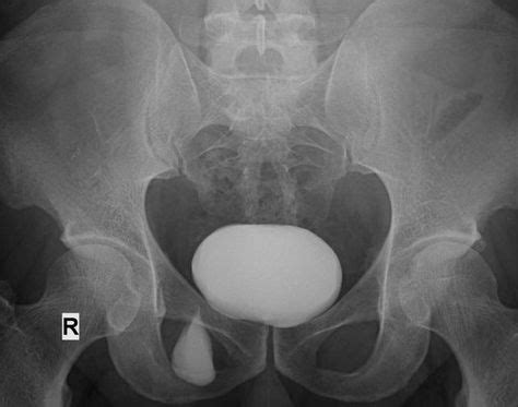 Ub Urinary Bladder In Inguinal Hernia With Images Radiology