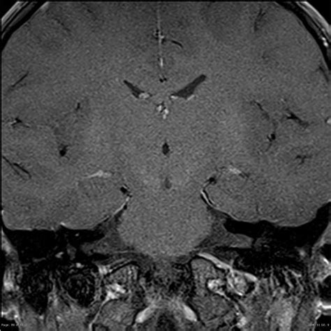 An Mri Scan Shows The Brain And Its Structures