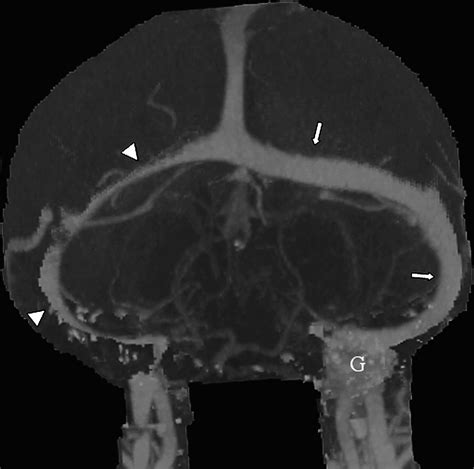 A Comparative Review Of Multidetector Ct Angiography And Mri In The