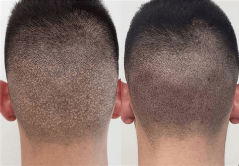 Hair Transplant Scars Whats Permanent And What Will Heal Explained By A Dermatologist