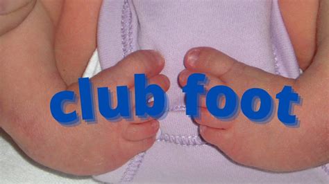 Club Foot Congenital Talipes Equinavarus Congenital Orthopedic Youtube