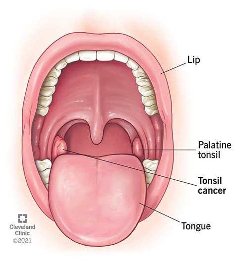 Oral cancer – Artofit