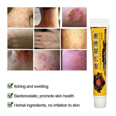 Psoriasis Antipruritic Ointment Herbal Antibacterial Cream Treat Eczema Dermatitis Anti Itch