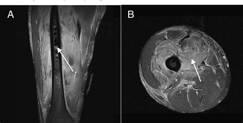 Figure 1 From Primary Fusobacterium Osteomyelitis And Pyomyositis Of