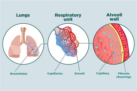 Pulmonary Fibrosis