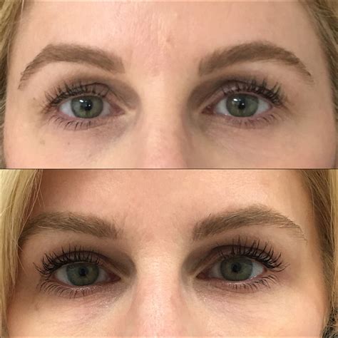 Upper Blepharoplasty Before After Photos Flora Levin Md