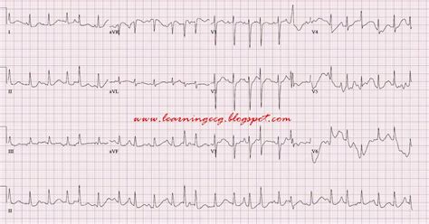 ECG Rhythms: Multifocal atrial tachycardia (MAT)/ Chaotic atrial tachycardia