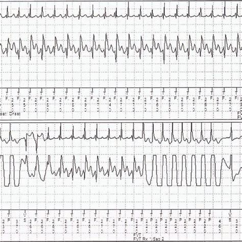 Ventricular Tachycardia Terminated By The Second Round Of Ventricular Download Scientific