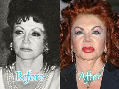 Jackie Stallone Plastic Surgery: Before After Bad Facelift, Fillers ...