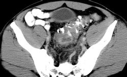 Diverticulitis: Imaging - Acute Abdomen Tutorial