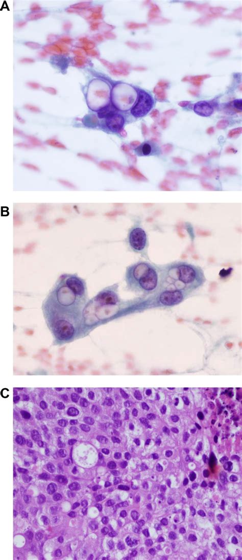 What Exactly Are The Cytoplasmic Inclusions In Metastatic Urothelial