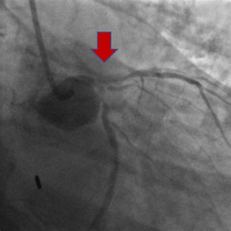 Coronary angioplasty or stenting - Central Heart