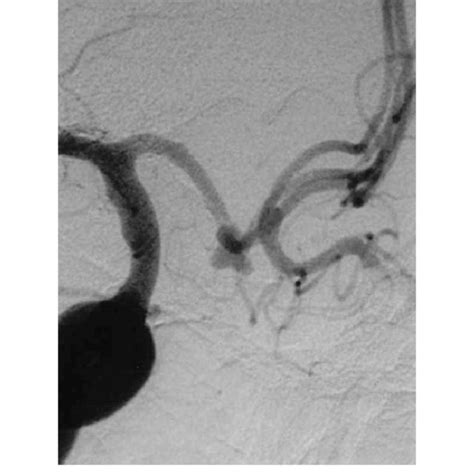 (PDF) Posterior temporal haematoma associated with anterior ...