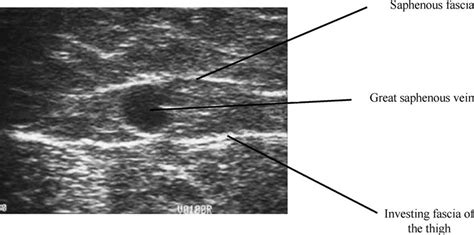 The Saphenous Eye A Transverse Ultrasound Image Of The GSV In The