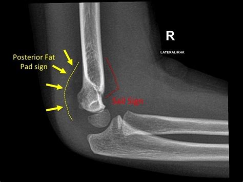 Posterior Fat Pad Sign Sail Sign Elevation Of The Anterior Fat Pad