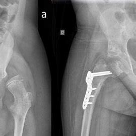 Preoperative And Last Follow Up Radiograph Of A Gmfcs V Patient Male