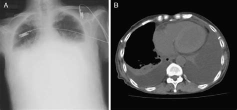 A Chest Radiograph Revealing Large Bilateral Pleural Effusion B