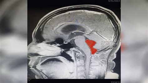 Tapeworm Removed From Texas Man’s Brain After Months Of Headaches Ktab