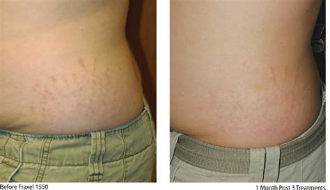 Best Stretch Mark Treatment In Australia Cutis Dermatology