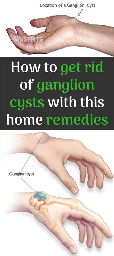 How To Get Rid Of Ganglion Cysts With This Home Remedies How To Get