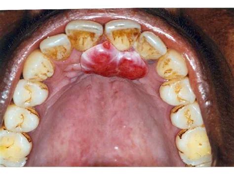 Peripheral Giant Cell Granuloma Vs Pyogenic Granuloma