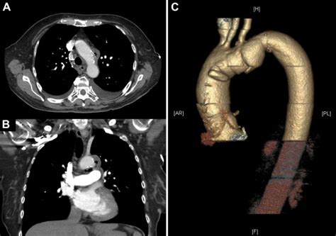 Autologous Pericardial Reconstruction Of Ruptured Salmonella Mycotic