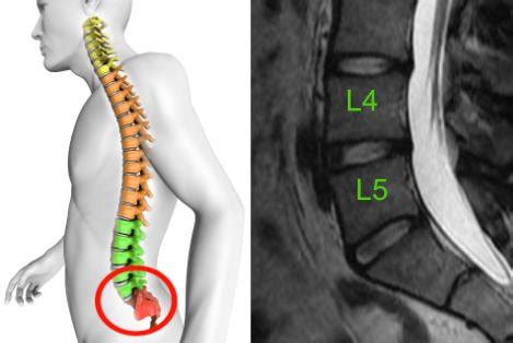 Dyskopatia L L Przyczyny Objawy Leczenie